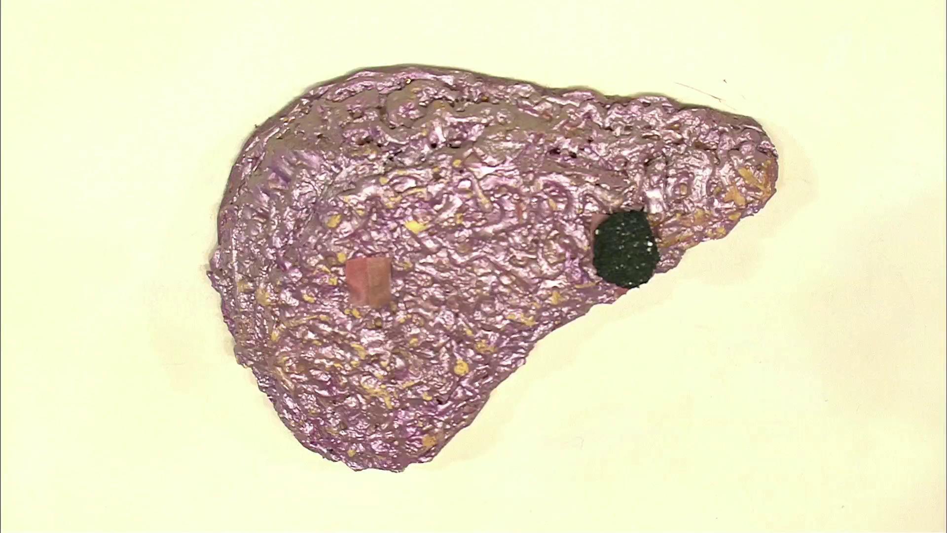 Печень после гепатита с. Мелкоузловой цирроз печени макропрепарат. Токсический гепатит макропрепарат. Токсический гепатит печени патанатомия.