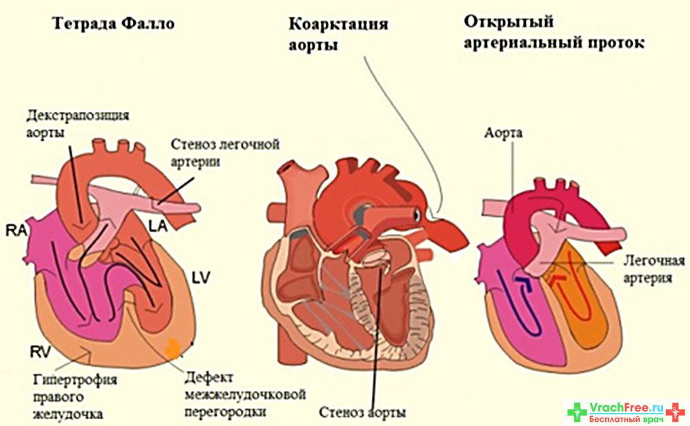 Обогащением малого круга кровообращения. Схемы врожденных пороков сердца. Приобретенные пороки сердца классификация. Классификация врожденных пороков сердца схема. Врождённые пороки сердца классификация рисунки.