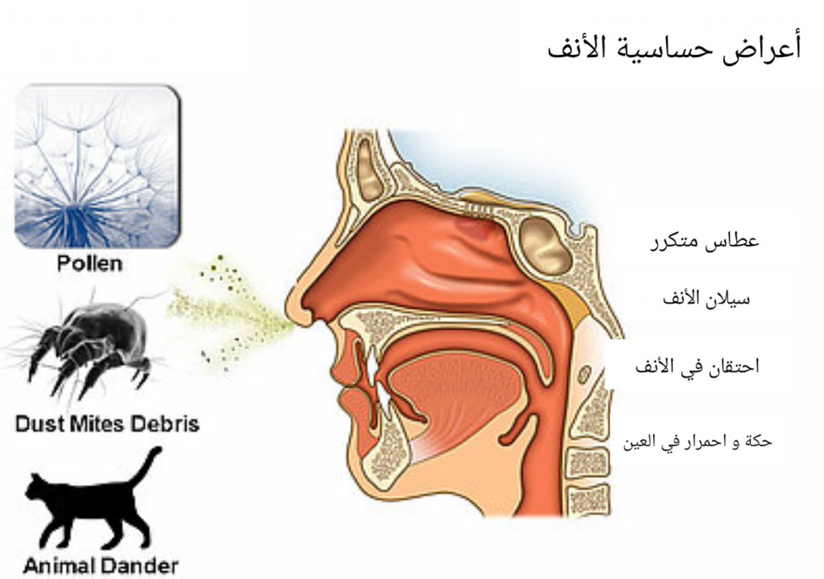 Почему течет вода из носа без простуды. Аллергический ринит в носу. Аллергик ринит.