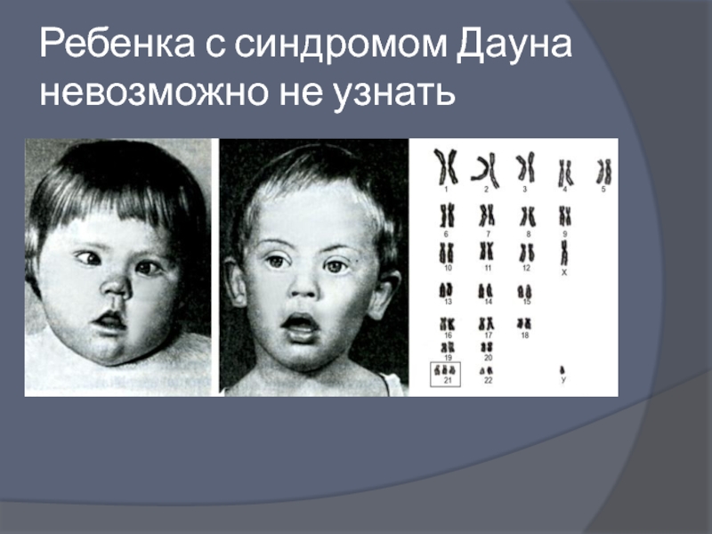 Фенотип ребенка с синдромом дауна. Синдром Дауна трисомия по 21 хромосоме. Мозаичный синдром Дауна внешность. Болезнь Дауна мозаичная форма.